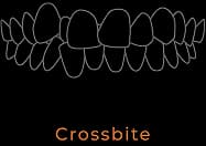 Crossbite illustration