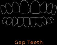 Gap Teeth illustration