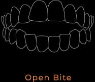 Open Bite illustration