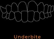 Underbite illustration