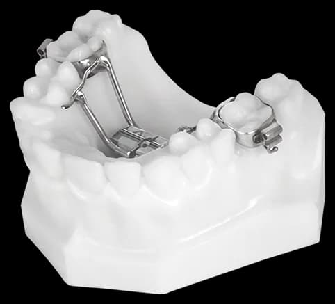 Rapid palatal expander on an upper arch