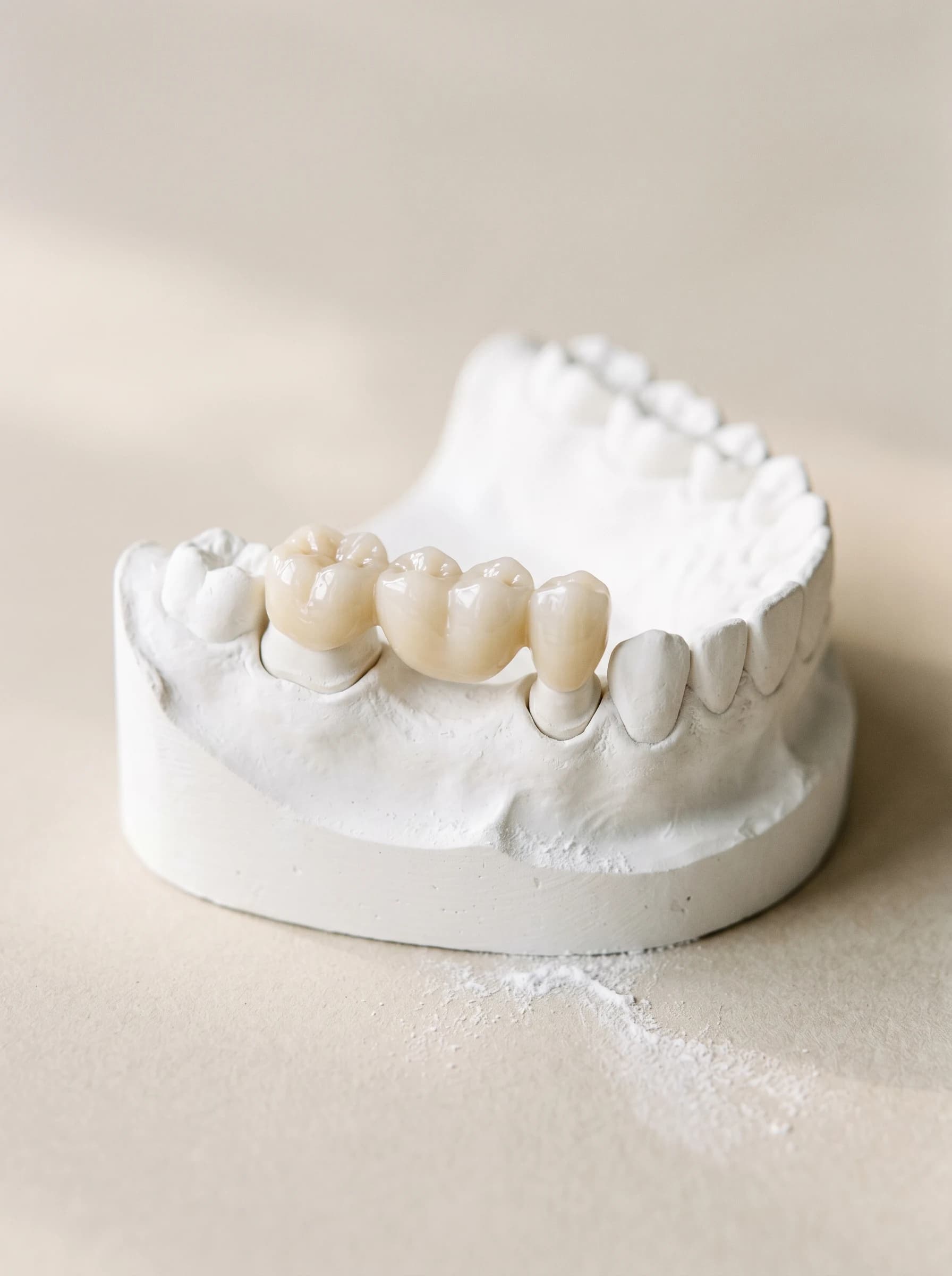 Three-unit ceramic bridge seated on a white plaster dental model