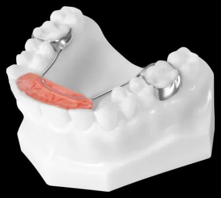 Fixed Anterior Bite Plate