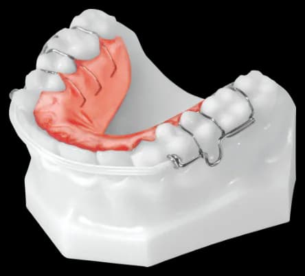Clear Bow Retainer (Upper)