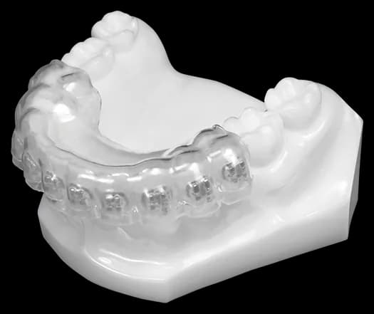 Indirect Bonding (Lower)