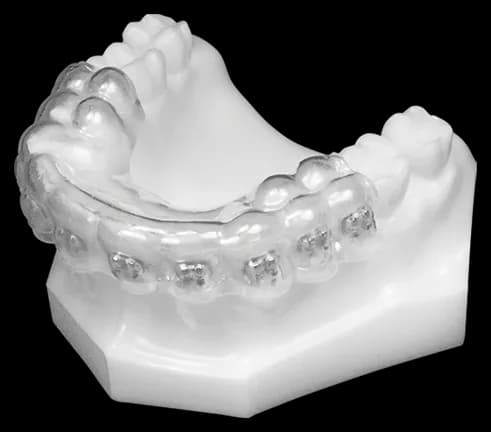 Indirect Bonding (Upper)
