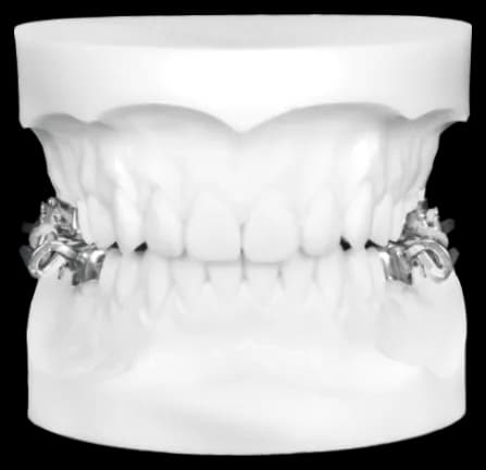 M.A.R.A. (Mandibular Advancing Repositioning Appliance)