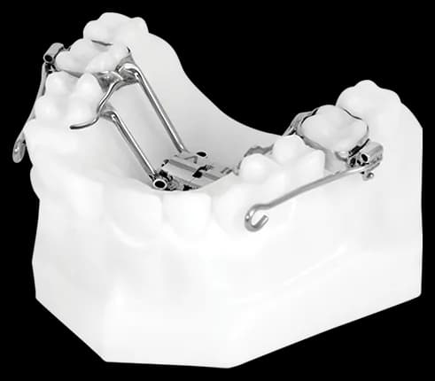M-M.A.R.P.E.® (Micro-Implant Assisted Rapid Palatal Expander)