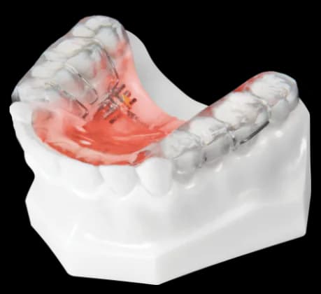 Sagittal Appliance 2 Way