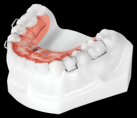 Schwartz Appliance with Adam Clasps (Lower)