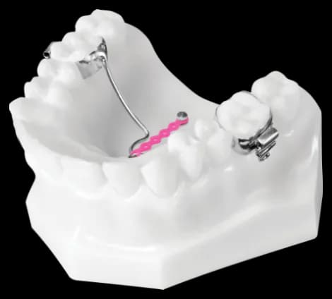 TAD MDE (Molar Distalizer with Elastic Chain)