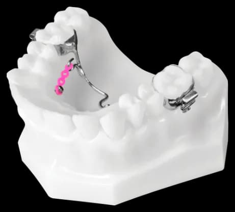 TAD PBD (Transpalatal Bar Distalizer with Hooks)