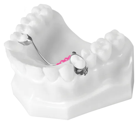 TAD TPB (Transpalatal Bar Distalizer with Elastic Chain)