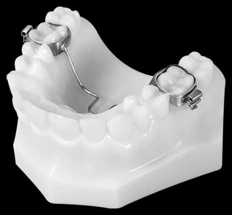 Transpalatal Arch Appliance